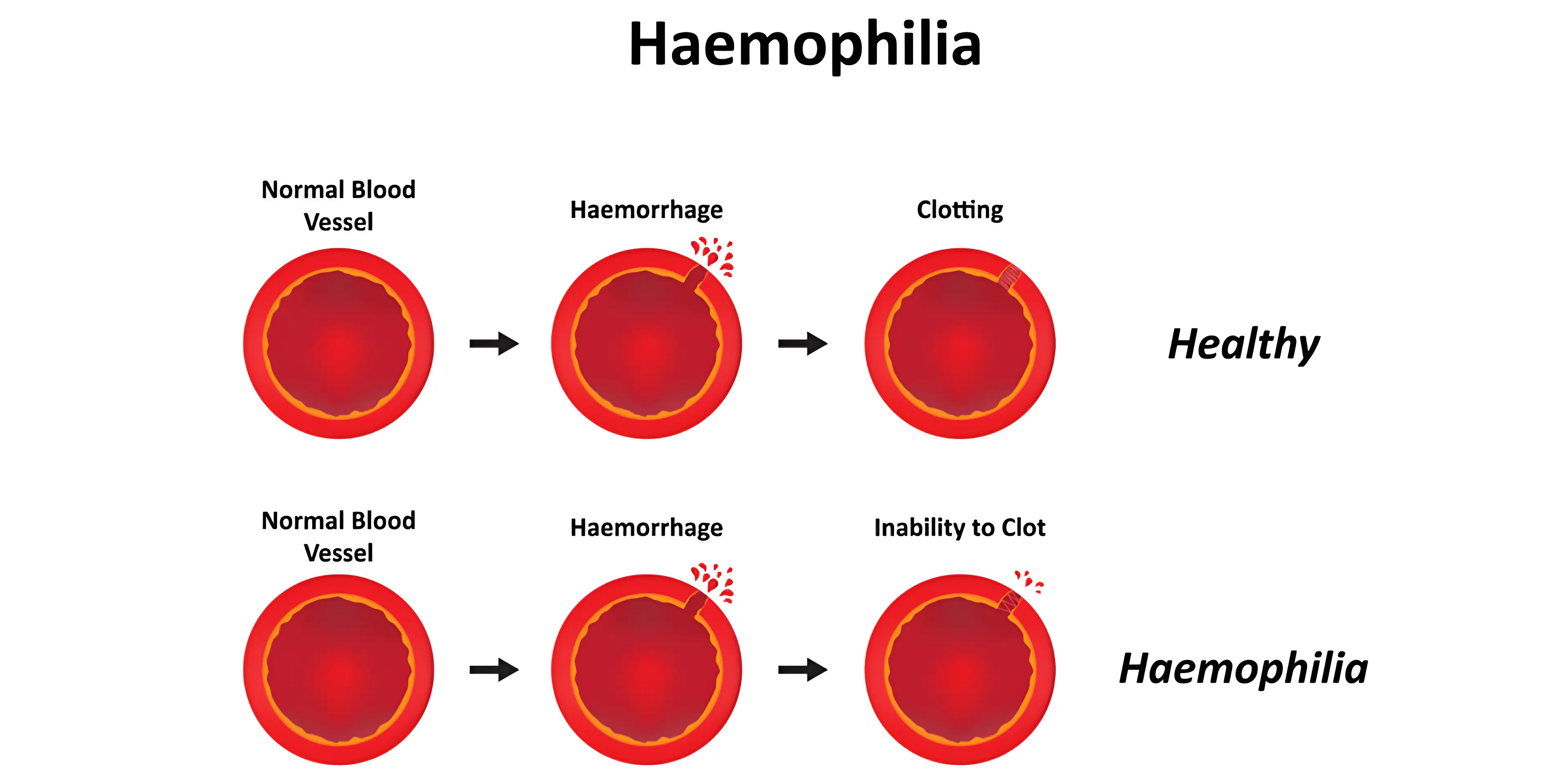 haemophilia