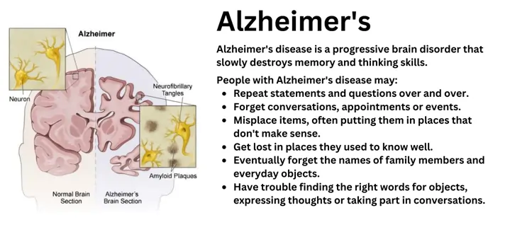 alzheimer